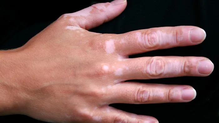 Gejala Vitiligo