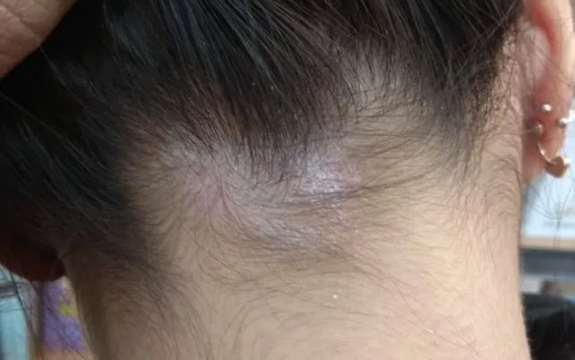 dermatitis seboroik