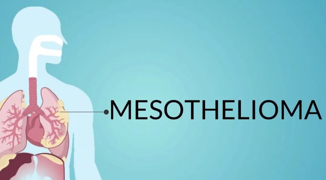 How to Choose a Top Mesothelioma Law Firm