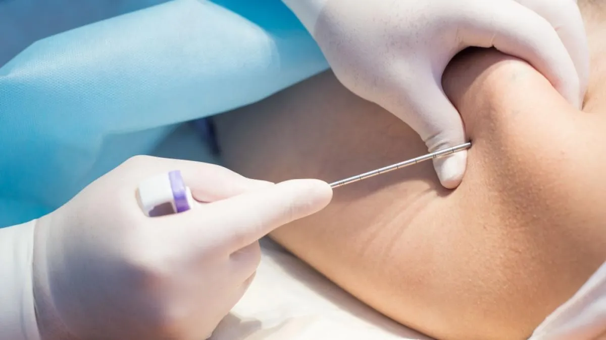 Prosedur Biopsi Sumsum Tulang Belakang